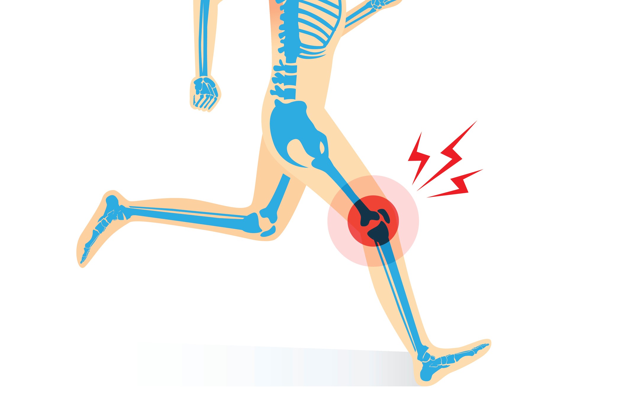 ランナー膝 足裏の痛み 捻挫 ランニングで起こりやすいケガと予防対策 健康 スポーツ Melos