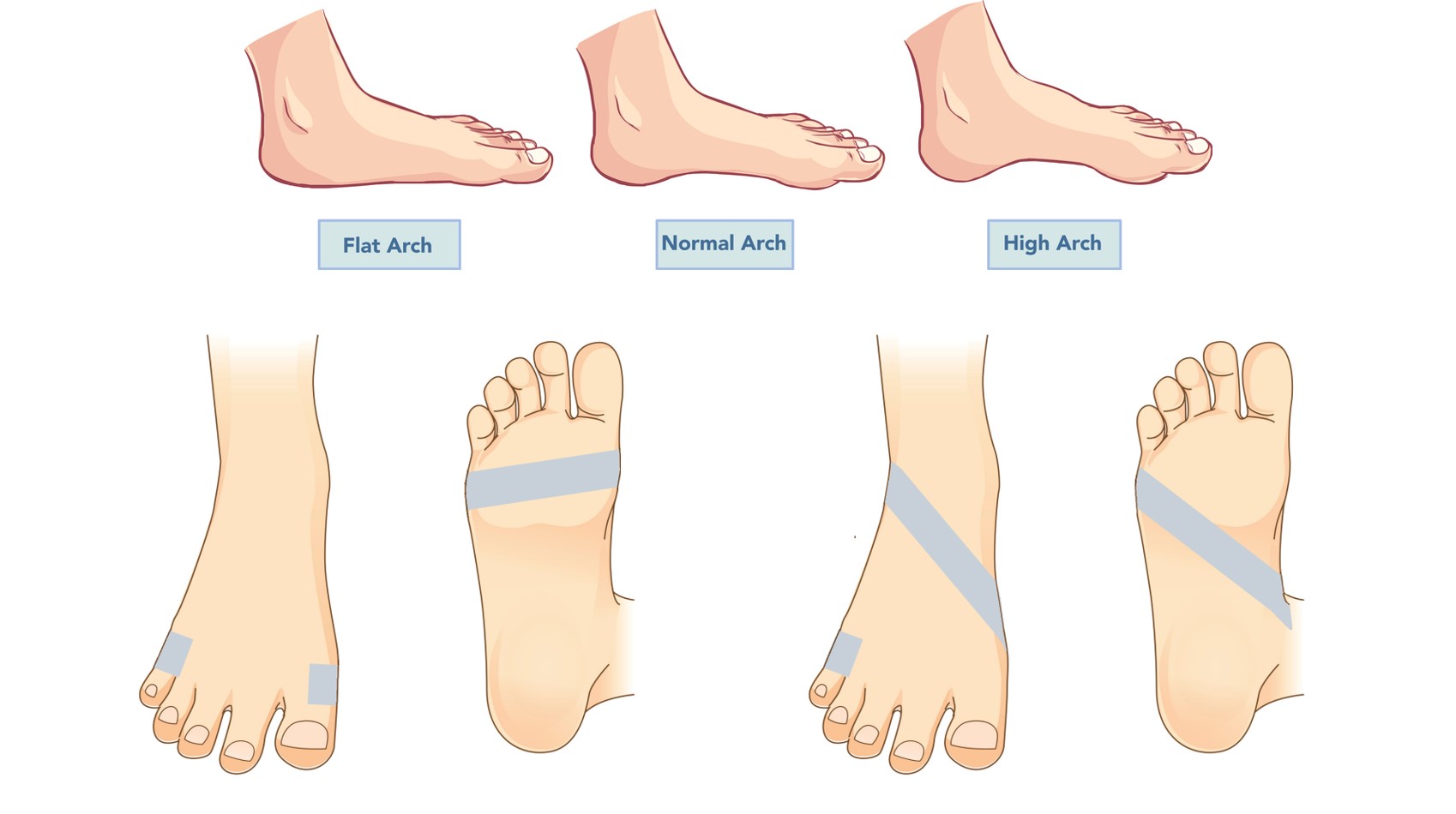 足裏が痛いのは アーチの崩れ が原因かも 解消法は 靴のインソール 中敷き と テーピング