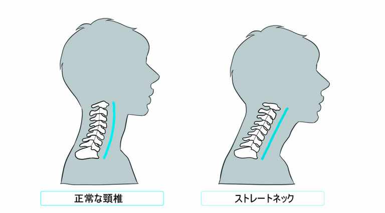 ストレートネック（スマホ首）の治し方：改善するおすすめストレッチ、原因、症状を徹底解説 医師監修 3149